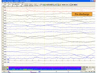 Pre discharge
 
