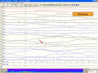 discharge
 