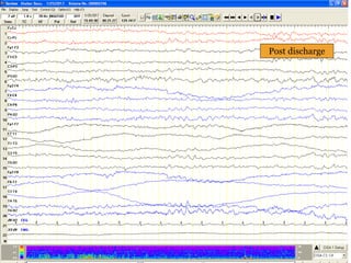 Post discharge
 