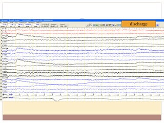 discharge
 