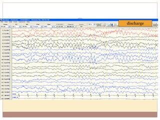 discharge
 