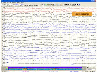 Pre discharge
 