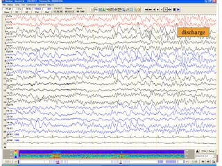 discharge
 