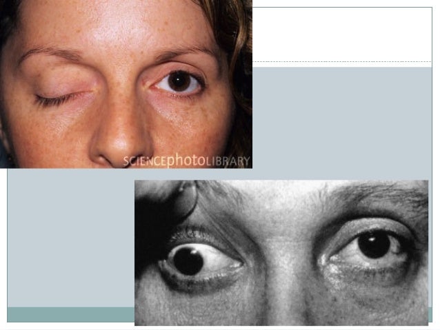 Sachin ppt neurophysio of eye movements