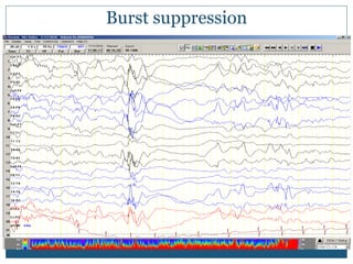 Burst suppression
 