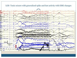 LGS- Tonic seizure with generalized spike and fast activity with EMG changes
 