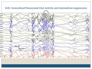 LGS- Generalized Paroxysmal Fast Activity and intermittent suppression
 