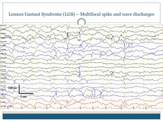 Lennox Gastaut Syndrome (LGS) – Multifocal spike and wave discharges
 