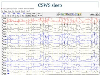 CSWS sleep
 