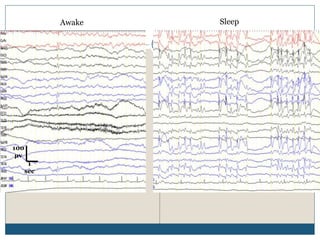 Awake Sleep
100
µv
1
sec
 