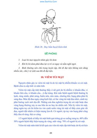 25
Hình 26. Day bấm huyệt Kiên tĩnh
ĐỀ PHÒNG
1. Loại bỏ mọi nguyên nhân gây lòi dom
2. Khi bị lòi dom phải đưa lại vị trí củ ngay và nằm nghỉ ngơi.
3. Binh thường nên chú trọng luyện tập, khi đi đại tiện không nên dùng
nhiều sức, chú ý vệ sinh sau khi đi đại tiện.
10. VIÊM TÚI MẬT
Nguyên nhân gây ra viêm túi mật là do túi mật bị nhiễm khuẩn và sỏi mật.
Bệnh chia ra cấp tính và mãn tính.
Viêm túi mật cấp tính thƣờng thấy ở nữ giới do bị nhiễm vi khuẩn đũa, vi
khuẩn liên cầu, vi khuẩn cầu... ở đại tràng. Khi mắc bệnh ngƣời bệnh thƣờng bị
lạnh, rùng mình, phát nóng, buồn nôn, nôn mửa, chƣớng khí, bụng phía phải bị
sƣng đau. Mức độ đau ngày càng kịch liệt, có lúc vùng túi mật đau nhói, cánh tay
phải buông xuôi mới dịu đỡ. Những cơn đau nghiêm trọng do sỏi mật hoặc đau
vùng bụng thƣờng xảy ra sau bữa ăn no hay ăn nhiều mỡ. Nếu bị viêm túi mật,
dùng ngón tay cái ấn kiểm tra vào cạnh sƣờn vùng túi mật sẽ thấy cảm giác rất
đau, ngƣời đột nhiên có hiện tƣợng lịm đi. Có ngƣời, ép tay vào bụng phải cũng
thấy đau rõ ràng, thịt co cứng.
1/3 ngƣời bệnh sẽ thấy túi mật hình quả trứng gà sa xuống sƣng to, 40% đến
50% ngƣời bệnh thấy hiện tƣợng da vàng, mắt vàng: 70% số ngƣời bị sỏi mật.
Viêm túi mật mãn tính là kết quả của viên túi mật cấp tính hoặc do bị sỏi kéo
www.SachVui.Com
 