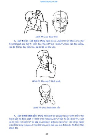 38
Hình 38: Day Toản trúc
3. Day huyệt Tinh minh: Dùng ngón tay cái, ngón trỏ tay phải ấn vào hai
bên mặt cách góc mắt 0,1 thốn day 30 đến 50 lần. (hình 39), trƣớc tiên day xuống,
sau đó đổi tay day bấm vào, lặp đi lặp lại nhƣ vậy.
Hình 39: Day huyệt Tinh minh.
Hình 40: Day dưới nhãn cầu
4. Day dƣới nhãn cầu: Dùng hai ngón tay cái gập lại day dƣới mắt ở hai
huyệt gần mi dƣới, cách 1/4 thôn từ mi ra ngoài, day 30 đến 50 lần (hình 40). Vuốt
da mi mắt: Hai ngón tay trỏ gập lại, dùng đốt giữa của ngón vuốt vào lớp da ngoài
mi mắt từ trong ra ngoài, trên mắt trƣớc, dƣói mắt sau. làm đi làm lại 30 đến 50 lần
(hình 41)
www.SachVui.Com
 