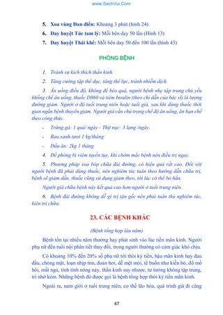 47
5. Xoa vùng Đan điển: Khoảng 3 phút (hình 24)
6. Day huyệt Túc tam lý: Mỗi bên day 50 lần (Hình 13)
7. Day huyệt Thái khê: Mỗi bên day 50 đến 100 lần (hình 43)
PHÒNG BỆNH
1. Tránh sự kích thích thần kinh.
2. Tăng cường tập thể dục, tăng thể lực, tránh nhiễm dịch.
3. Ăn uống điều độ, không để béo quá, người bệnh nhẹ tập trung chủ yếu
khống chế ăn uống, thuốc D860 và tiêm Insulin (theo chỉ dẫn của bác sĩ) là lượng
đường giảm. Người ở độ tuổi trung niên hoặc tuổi già, sau khi dùng thuốc thời
gian ngắn bệnh thuyên giảm. Người già cần chú trọng chế độ ăn uống, ăn hạn chế
theo công thức.
- Trứng gà: 1 quả/ ngày - Thịt nạc: 3 lạng /ngày.
- Rau xanh tươi 1 kg/tháng
- Dầu ăn: 2kg 1 tháng
4. Đề phòng bị viêm tuyến tụy, khi chớm mắc bệnh nên điều trị ngay.
5. Phương pháp xoa bóp chữa đái đường, có hiệu quả rất cao. Đối với
người bệnh đã phải dùng thuốc, nên nghiêm túc tuân theo hướng dẫn chữa trị,
bệnh sẽ giảm dần, thuốc cũng sử dụng giảm theo, tới lúc có thể bỏ hắn.
Người già chữa bệnh này kết quả cao hơn người ở tuổi trung niên.
6. Bệnh đái đường không dễ gì trị tận gốc nên phải tuân thủ nghiêm túc,
kiên trì chữa.
23. CÁC BỆNH KHÁC
(Bệnh tổng hợp lâu năm)
Bệnh tồn tại nhiều năm thƣờng hay phát sinh vào lúc tiền mãn kinh. Ngƣời
phụ nữ đến tuổi nội phân tiết thay đổi, trong ngƣời thƣờng có cảm giác khó chịu.
Có khoảng 10% đến 20% số phụ nữ tới thòi kỳ tiền, hậu mãn kinh hay đau
đầu, chóng mặt, loạn nhịp tim, đoản hơi, dễ mệt mỏi, tê buồn nhƣ kiến bò, đổ mồ
hôi, mất ngủ, tính tình nóng nảy, thần kinh suy nhƣợc, tƣ tƣởng không tập trung,
trí nhớ kém. Những bệnh đó đƣợc gọi là bệnh tổng hợp thời kỳ tiền mãn kinh.
Ngoài ra, nam giới ở tuổi trung niên, cơ thế lão hóa, quá trình già đi cũng
www.SachVui.Com
 