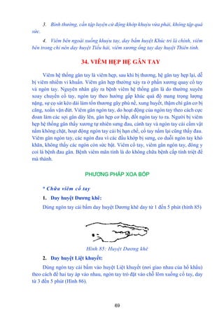 69
3. Bình thường, cần tập luyện cử động khớp khuỷu vừa phải, không tập quá
sức.
4. Viêm bên ngoài xuống khuỷu tay, day bấm huyệt Khúc tri là chính, viêm
bên trong chỉ nên day huyệt Tiểu hải, viêm xương ống tay day huyệt Thiên tỉnh.
34. VIÊM HẸP HỆ GÂN TAY
Viêm hệ thống gân tay là viêm hẹp, sau khi bị thƣơng, hệ gân tay hẹp lại, dễ
bị viêm nhiểm vi khuẩn. Viêm gân hẹp thƣờng xảy ra ở phần xƣơng quay cổ tay
và ngón tay. Nguyên nhân gây ra bệnh viêm hệ thống gân là do thƣờng xuyên
xoay chuyển cổ tay, ngón tay theo hƣớng gấp khúc quá độ mang trọng lƣợng
nặng, sự cọ sát kéo dài làm tổn thƣơng gây phù nề, xung huyết, thậm chí gân cơ bị
căng, xoắn vặn đứt. Viêm gân ngón tay, do hoạt động của ngón tay theo cách cực
đoan làm các sợi gân dày lên, gân hẹp cơ bắp, đốt ngón tay to ra. Ngƣời bị viêm
hẹp hệ thống gân thấy xƣơng tự nhiên sƣng đau, cánh tay và ngón tay cái cầm vật
nắm không chặt, hoạt động ngón tay cái bị hạn chế, cổ tay nắm lại cũng thấy đau.
Viêm gân ngón tay, các ngón đau vì các đầu khớp bị sƣng, co duỗi ngón tay khó
khăn, không thấy các ngón còn sức bật. Viêm cổ tay, viêm gân ngón tay, đông y
coi là bệnh đau gân. Bệnh viêm mãn tính là do không chữa bệnh cấp tính triệt để
mà thành.
PHƯƠNG PHÁP XOA BÓP
* Chữa viêm cổ tay
1. Day huyệt Dƣơng khê:
Dùng ngón tay cái bấm day huyệt Dƣơng khê day từ 1 đến 5 phút (hình 85)
Hình 85: Huyệt Dương khê
2. Day huyệt Liệt khuyết:
Dùng ngón tay cái bấm vào huyệt Liệt khuyết (nơi giao nhau của hổ khẩu)
theo cách để hai tay áp vào nhau, ngón tay trỏ đặt vào chỗ lõm xuống cổ tay, day
từ 3 đến 5 phút (Hình 86).
 