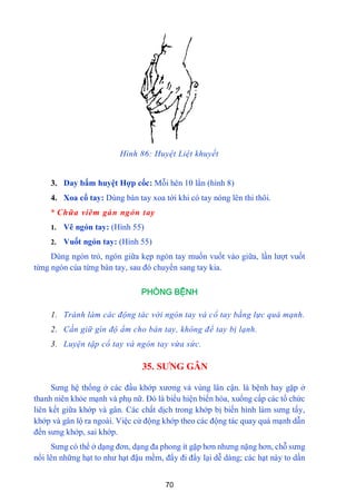 70
Hình 86: Huyệt Liệt khuyết
3. Day bấm huyệt Hợp cốc: Mỗi hên 10 lẩn (hình 8)
4. Xoa cổ tay: Dùng bàn tay xoa tới khi có tay nóng lên thi thôi.
* Chữa viêm gán ngón tay
1. Vê ngón tay: (Hình 55)
2. Vuốt ngón tay: (Hình 55)
Dùng ngón trỏ, ngón giữa kẹp ngón tay muốn vuốt vào giữa, lần lƣợt vuốt
từng ngón cùa từng bàn tay, sau đó chuyển sang tay kia.
PHÒNG BỆNH
1. Tránh làm các động tác với ngón tay và cổ tay bằng lực quá mạnh.
2. Cần giữ gìn độ ẩm cho bàn tay, không để tay bị lạnh.
3. Luyện tập cổ tay và ngón tay vừa sức.
35. SƢNG GÂN
Sƣng hệ thống ở các đầu khớp xƣơng và vùng lân cận. là bệnh hay gặp ở
thanh niên khỏe mạnh và phụ nữ. Đó là biểu hiện biến hóa, xuống cấp các tổ chức
liên kết giữa khớp và gân. Các chất dịch trong khớp bị biến hình làm sƣng tấy,
khớp và gân lộ ra ngoài. Việc cử động khớp theo các động tác quay quá mạnh dẫn
đến sƣng khớp, sai khớp.
Sƣng có thể ở dạng đơn, dạng đa phong ít gặp hơn nhƣng nặng hơn, chỗ sƣng
nổi lên những hạt to nhƣ hạt đậu mềm, đẩy đi đẩy lại dễ dàng; các hạt này to dần
 