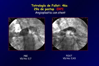 Tetralogía de Fallot: 46a
          29a de postop ERPI
           Angioplastia con stent




   PRE                          POST
VD/Ao: 0,7                    VD/Ao: 0,43
 