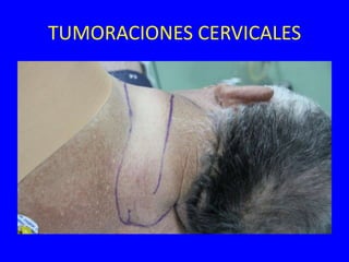 TUMORACIONES CERVICALES
 