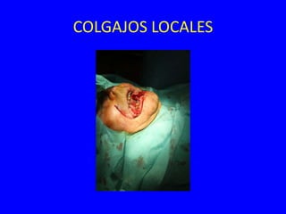 COLGAJOS LOCALES
 