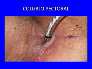 COLGAJO PECTORAL
 
