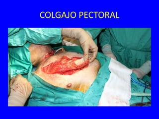 COLGAJO PECTORAL
 