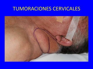 TUMORACIONES CERVICALES
 