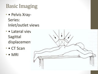 Sacral fracture | PPTX