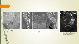 Xray
CT
Sacral insufficiency
fracture on mri
 