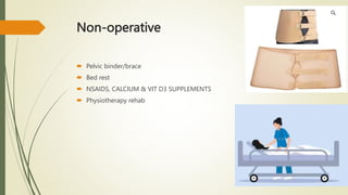Non-operative
 Pelvic binder/brace
 Bed rest
 NSAIDS, CALCIUM & VIT D3 SUPPLEMENTS
 Physiotherapy rehab
 