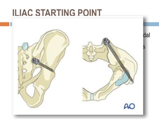 ILIAC STARTING POINT
 is referred to as anatomic starting point. It is more caudal
and medial than the traditional starting point and aligns
better with the lumbar pedicles.
 The more caudal position places this screw in a wider
cross section of bone above the sciatic notch
 