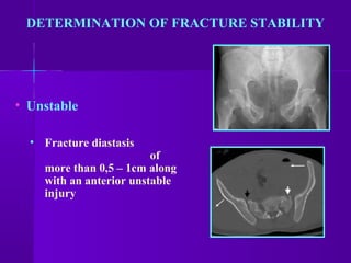 DETERMINATION OF FRACTURE STABILITY
• Unstable
• Fracture diastasis
of
more than 0,5 – 1cm along
with an anterior unstable
injury
 