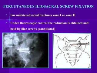PERCUTANEOUS ILIOSACRAL SCREW FIXATION
• For unilateral sacral fractures zone I or zone II
• Under fluoroscopic control the reduction is obtained and
held by iliac screws (cannulated)
 
