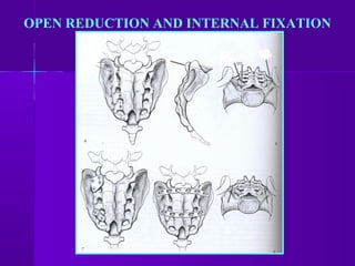 OPEN REDUCTION AND INTERNAL FIXATION
 