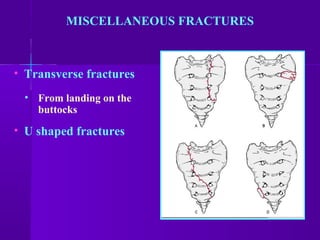 MISCELLANEOUS FRACTURES
• Transverse fractures
• From landing on the
buttocks
• U shaped fractures
 