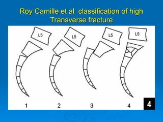 Raymond Roy Classification sacral spine injuries Assessment and manageent | PPT