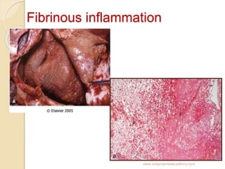 Fibrinous inflammation
www.indiandentalacademy.com
 