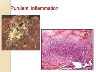 Purulent inflammation
www.indiandentalacademy.com
 