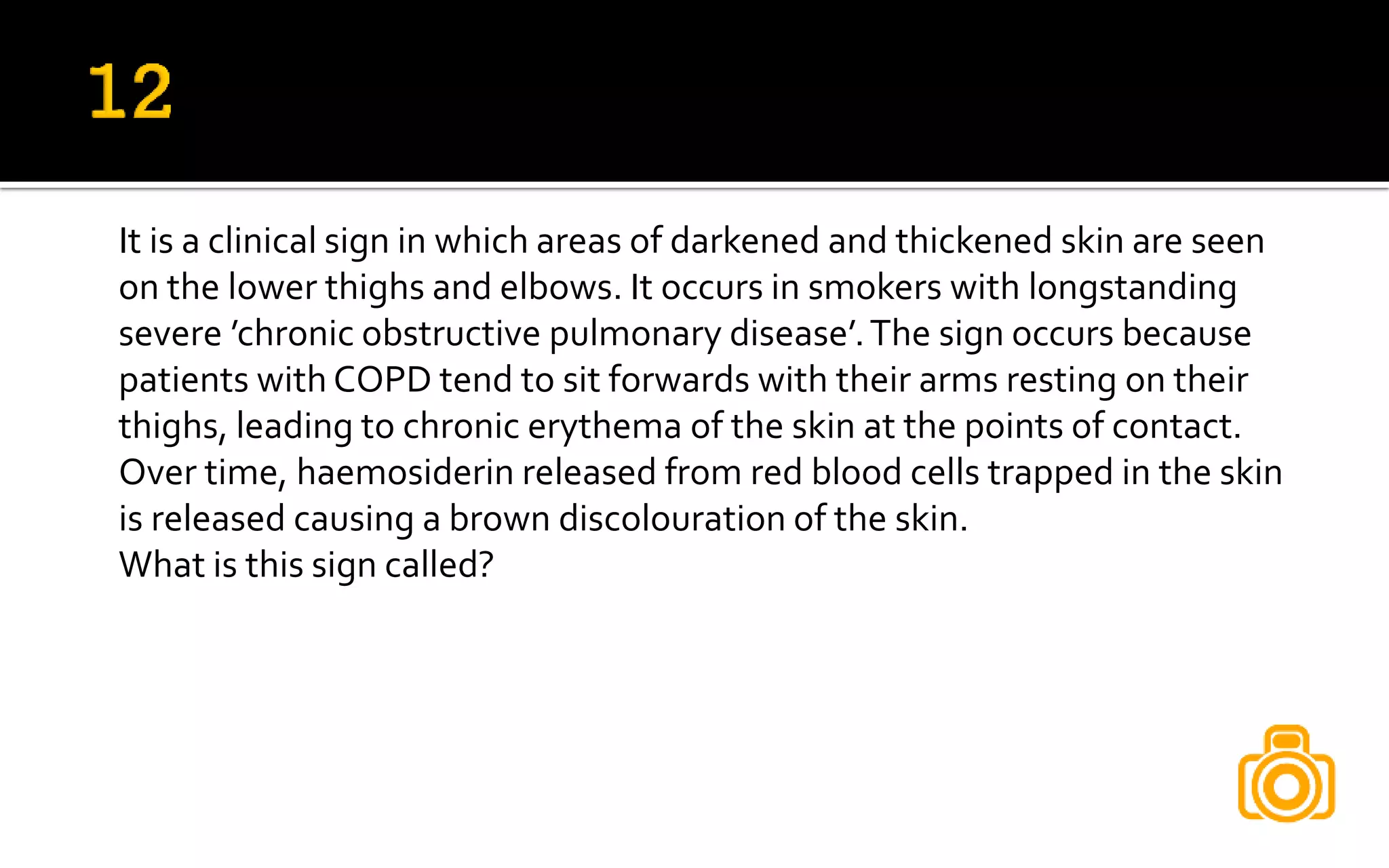 It is a clinical sign in which areas of darkened and thickened skin are seen
on the lower thighs and elbows. It occurs in smokers with longstanding
severe ’chronic obstructive pulmonary disease’.The sign occurs because
patients with COPD tend to sit forwards with their arms resting on their
thighs, leading to chronic erythema of the skin at the points of contact.
Over time, haemosiderin released from red blood cells trapped in the skin
is released causing a brown discolouration of the skin.
What is this sign called?
 
