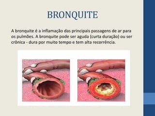 BRONQUITE
A bronquite é a inflamação das principais passagens de ar para
os pulmões. A bronquite pode ser aguda (curta duração) ou ser
crônica - dura por muito tempo e tem alta recorrência.
 
