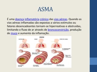 ASMA
É uma doença inflamatória crónica das vias aéreas. Quando as
vias aéreas inflamadas são expostas a vários estímulos ou
fatores desencadeantes tornam-se hiperreativas e obstruídas,
limitando o fluxo de ar através de broncoconstrição, produção
de muco e aumento da inflamação.
 