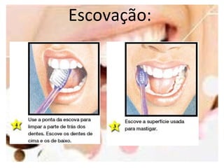 Escovação:
 