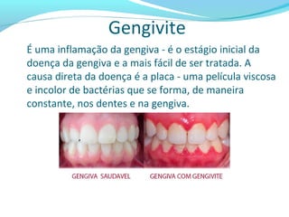 Gengivite
É uma inflamação da gengiva - é o estágio inicial da
doença da gengiva e a mais fácil de ser tratada. A
causa direta da doença é a placa - uma película viscosa
e incolor de bactérias que se forma, de maneira
constante, nos dentes e na gengiva.
 