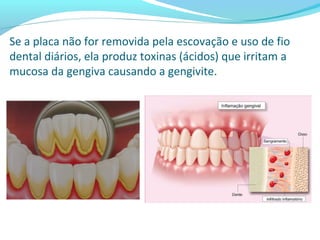Se a placa não for removida pela escovação e uso de fio
dental diários, ela produz toxinas (ácidos) que irritam a
mucosa da gengiva causando a gengivite.
 