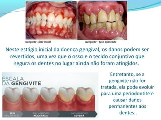 Neste estágio inicial da doença gengival, os danos podem ser
revertidos, uma vez que o osso e o tecido conjuntivo que
segura os dentes no lugar ainda não foram atingidos.
Entretanto, se a
gengivite não for
tratada, ela pode evoluir
para uma periodontite e
causar danos
permanentes aos
dentes.
 