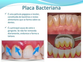 Placa Bacteriana
 É uma película pegajosa e incolor,
constituída de bactérias e restos
alimentares que se forma sobre os
dentes.
 É a principal causa de cárie e
gengivite. Se não for removida
diariamente, endurece e forma o
tártaro.
 