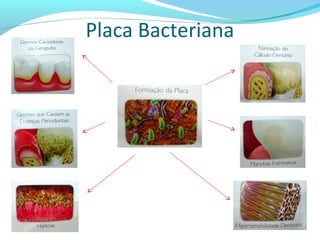 Placa Bacteriana
 