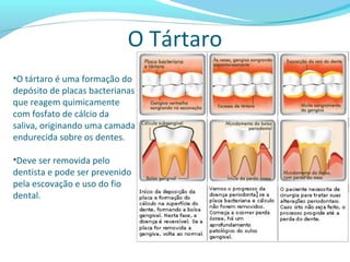 O Tártaro
•O tártaro é uma formação do
depósito de placas bacterianas
que reagem quimicamente
com fosfato de cálcio da
saliva, originando uma camada
endurecida sobre os dentes.
•Deve ser removida pelo
dentista e pode ser prevenido
pela escovação e uso do fio
dental.
 