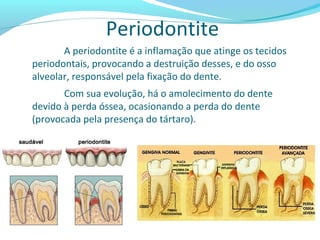 Periodontite
A periodontite é a inflamação que atinge os tecidos
periodontais, provocando a destruição desses, e do osso
alveolar, responsável pela fixação do dente.
Com sua evolução, há o amolecimento do dente
devido à perda óssea, ocasionando a perda do dente
(provocada pela presença do tártaro).
 