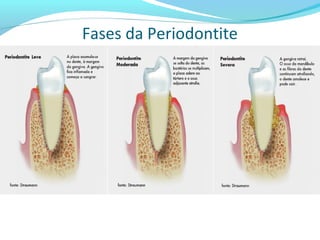 Fases da Periodontite
 