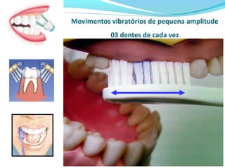 Movimentos vibratórios de pequena amplitude
03 dentes de cada vez
 