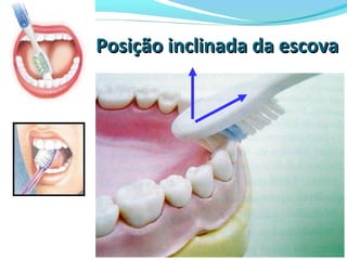 Posição inclinada da escovaPosição inclinada da escova
 